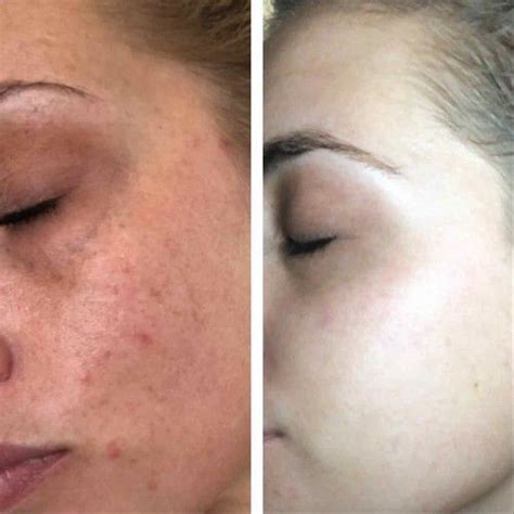 lumispa before and after acne|Lumi Spa * BEFORE & AFTER .
